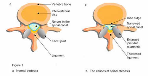 spinal stenosis cross section of vertabrae